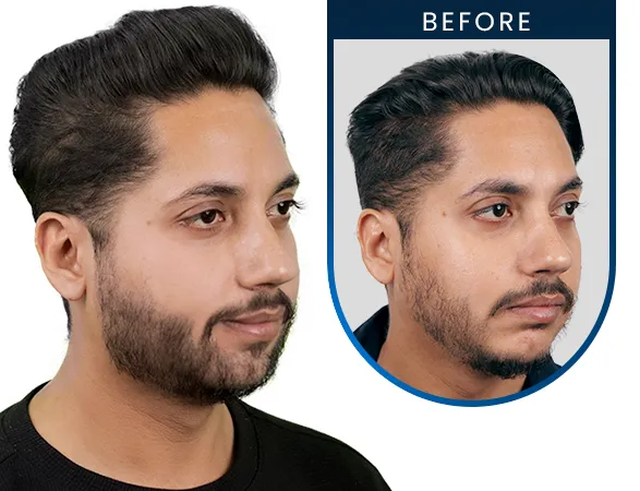 Hair Transplant 