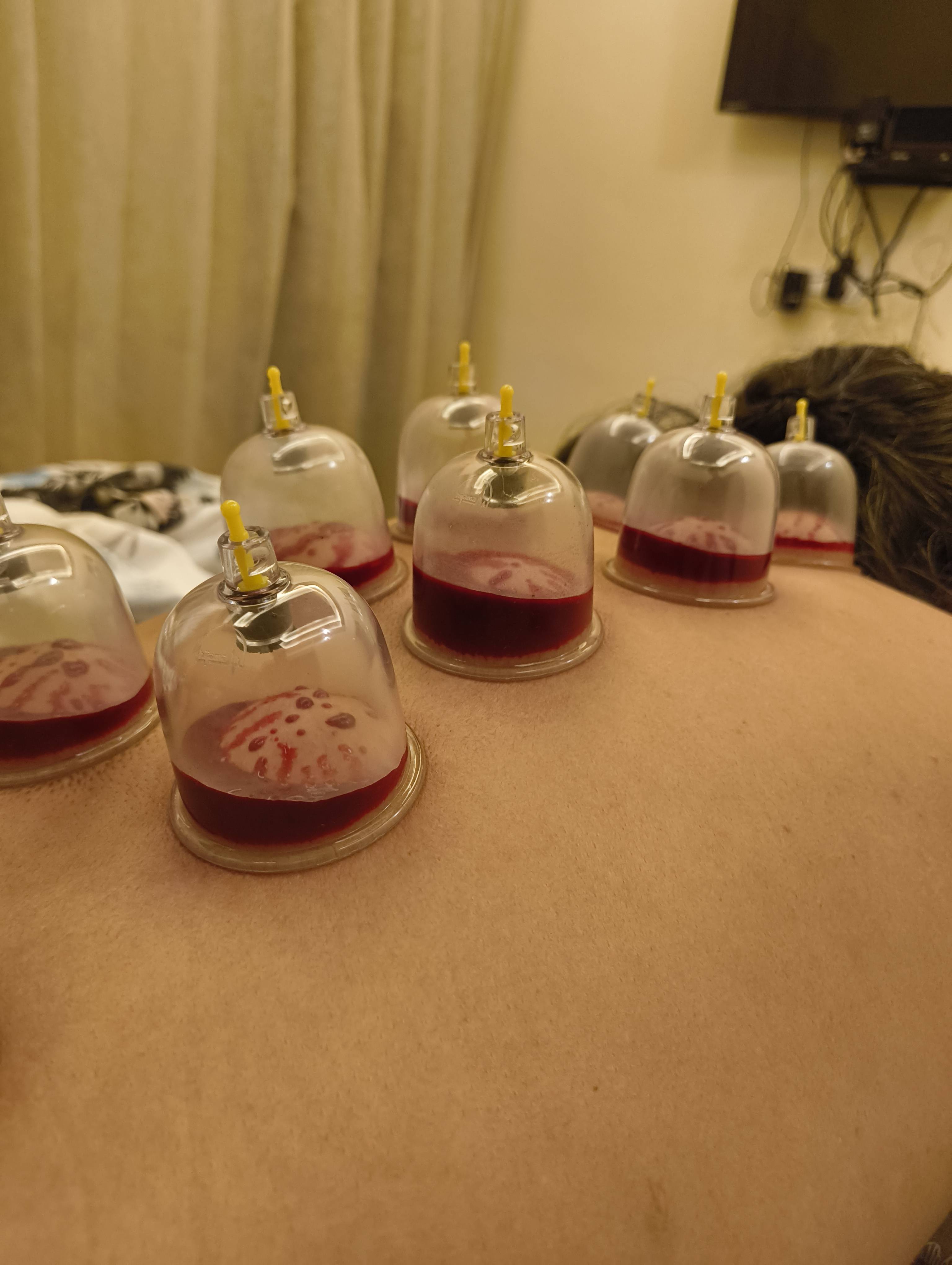 Cupping Therapy