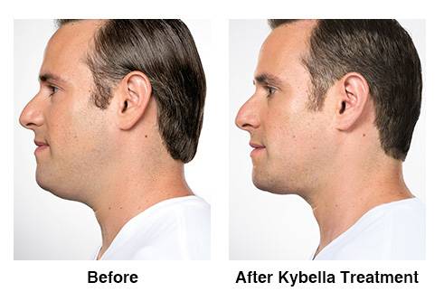  Kybella Injections: Buy Kybella Treatments Near Me