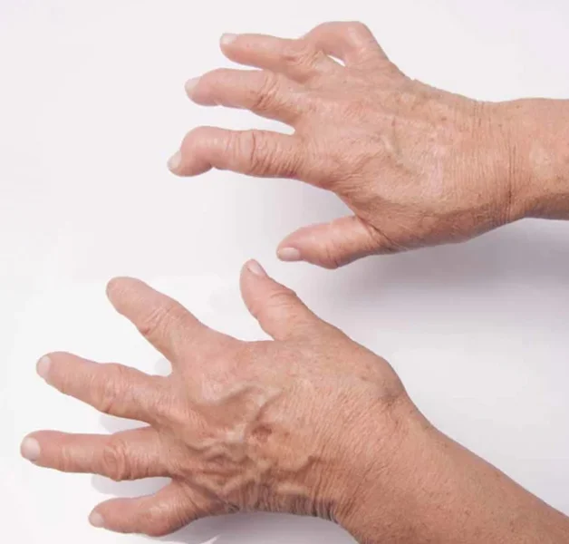Rheumatoid Arthritis