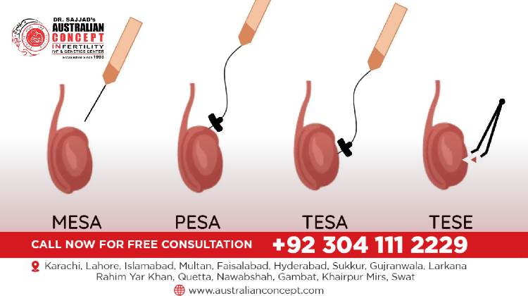 IVF, Micro TESE, Male infertility Treatment