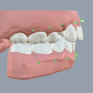 Kristelle Klear Aligners